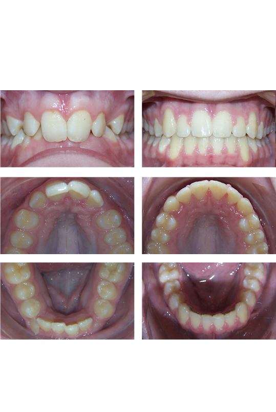 Front top and bottom of smile before and after orthodontic treatment