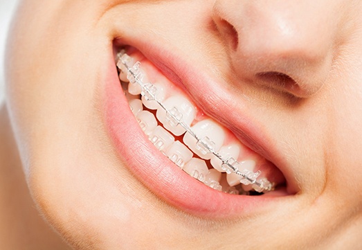 Closeup of traditional braces in Arlington Heights