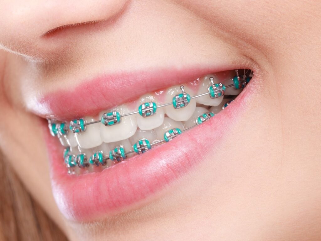 closeup of teen with braces smiling